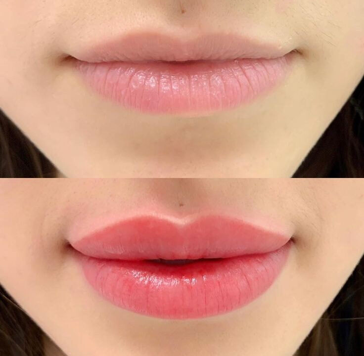 Kỹ thuật hút mực xăm môi